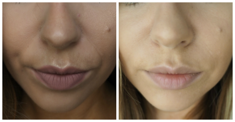 Dermal Fillers Nose to Mouth Lines