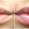 Lip Voltage Before and After